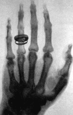 Première image radiologique en 1895 - Journée internationale de la radiologie